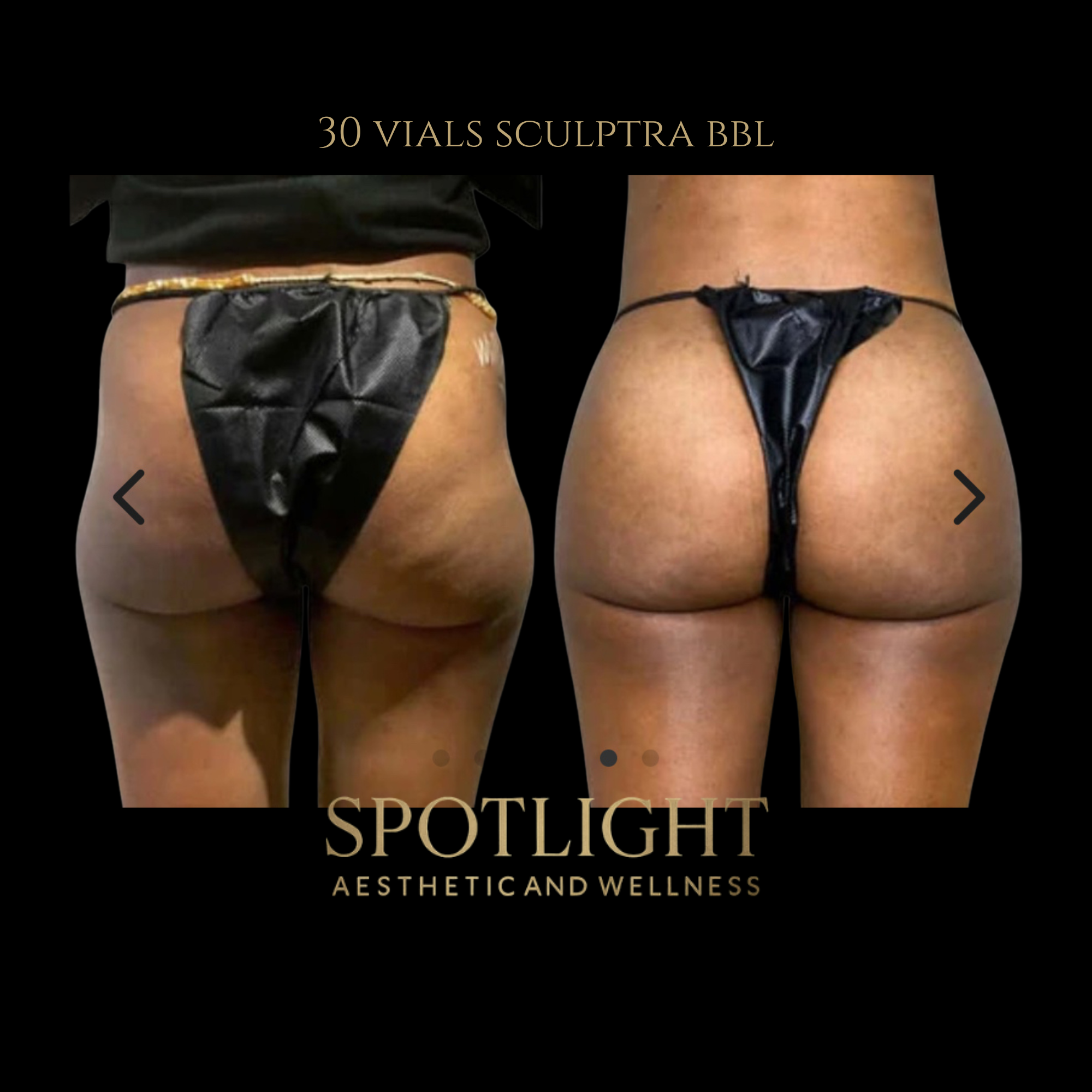 Full BBL Transformation - 30 Vials - Before and after aesthetic treatment results by Melissa Singleton PA-C