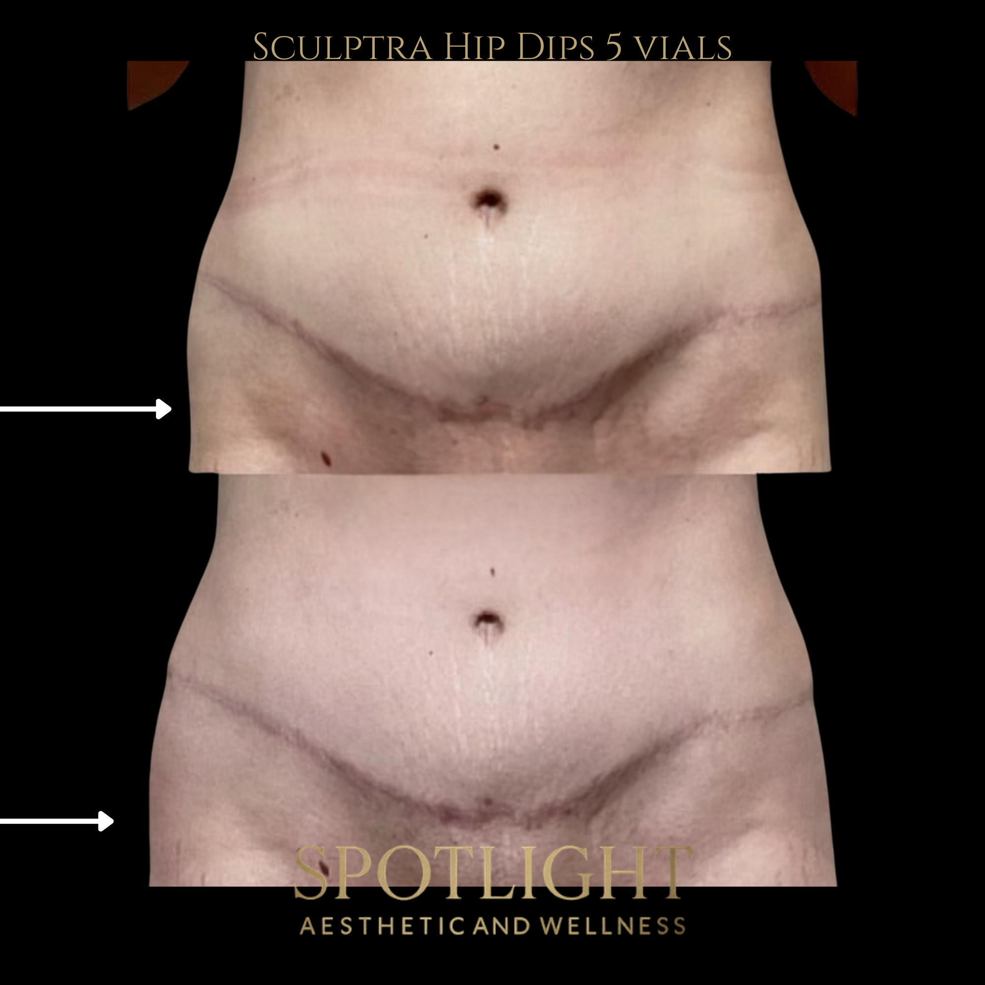 Hip Dip Correction - 5 Vials - Before and after aesthetic treatment results by Melissa Singleton PA-C